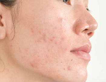 Jeune femme avec de l'acné sur le visage